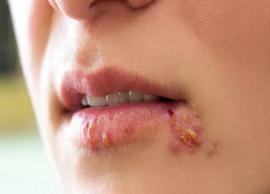 5 Ways To Treat Herpes at Home