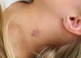 6 Remedies You Can Try To Get Rid of Hickeys
