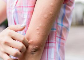 12 Home Remedies To Treat Hives