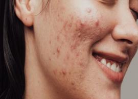 Hormonal Acne: Causes, How To Treat It, And Foods To Avoid