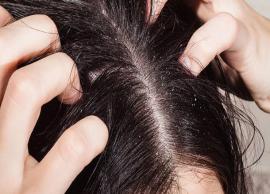 5 Natural Ways To Treat Itchy Scalp