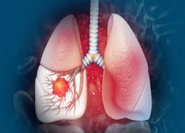 Major Symptoms and Causes of Lung Cancer