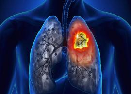 5 Signs of Lung Cancer That Should not Be Ignored