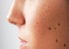 6 Home Remedies To Treat Skin Moles