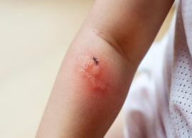 5 Home Remedies To Treat Mosquito Bites