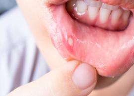 8 Home Remedies To Treat Mouth Ulcers