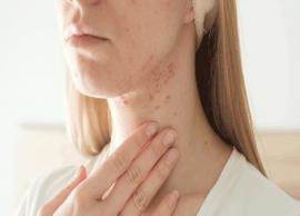 10 Effective Home Remedies To Get Rid of Neck Acne