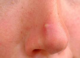 Quick Home Remedies To Help You Get Rid of Nose Acne
