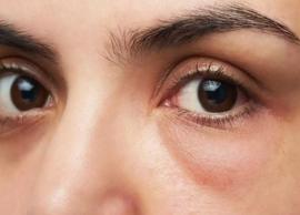 4 Remedies To Treat Puffy Eyes at Home