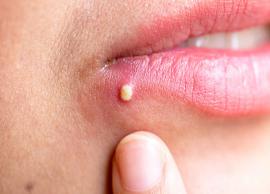 Easy Home Remedies To Get Rid of Pimples on Lip