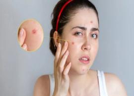 8 Simple Yet Effective Home Remedies To Treat Pimples