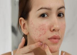 6 Most Common Tips To Avoid Pimples