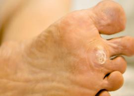4 Must Try Remedies To Treat Plantar Warts at Home

