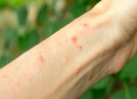 6 Remedies To Treat Poison Ivy at Home