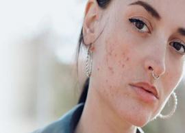 Want To Get Rid of Acne? Try These 5 Remedies