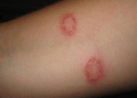 6 Remedies To Treat Ringworm Naturally