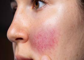 4 Remedies To Treat Rosacea Naturally