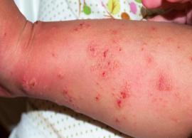 7 Remedies To Treat Scabies Naturally