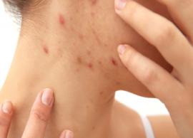 5 Effective Home Remedies To Treat Scabies