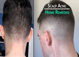 10 Home Remedies To Treat Scalp Acne
