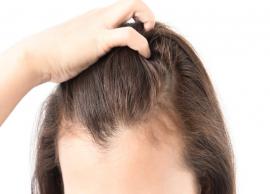 5 Home Remedies To Get Rid of Scalp Psoriasis