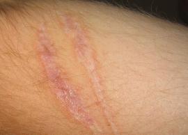 5 Home Remedies To Get Rid of Scars