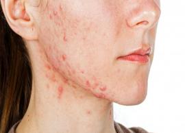 7 Effective Remedies To Treat Chicken Pox Scars Naturally