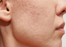 4 Ways To Treat Acne Scar Naturally