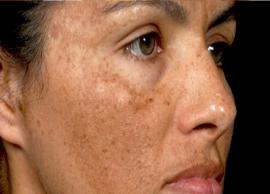 4 DIY Face Packs To Treat Skin Pigmentation
