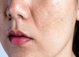 Few Home Remedies to Get Rid of Pigmentation