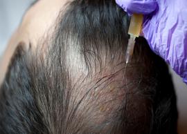 Everything You Need To Know About Stem Cell Therapy For Hair Baldness