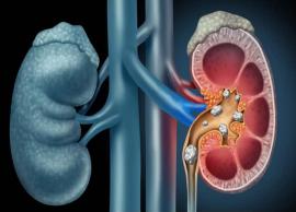 10 Home Remedies To Help You Get Rid of Kidney Stone