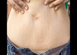 5 Home Remedies To Get Rid of Stretch Marks