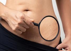 6 Effective Home Remedies To Treat Stretch Marks