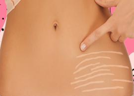 6 Natural Remedies To Get Rid of Stretch Marks