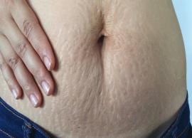 5 Natural Remedies You Can Try To Treat Pregnancy Stretch Marks