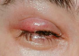 5 Remedies To Get Rid of a Stye in Your Eye