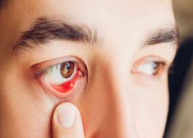 7 Home Remedies To Speed Up The Process for Styes