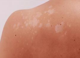 Get Rid of White Sunspots With These 8 Home Remedies