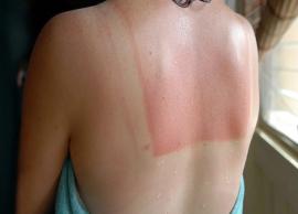 5 Things You Should Never Put on Sunburn