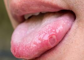 19 Home Remedies To Get Rid of Tongue Blisters
