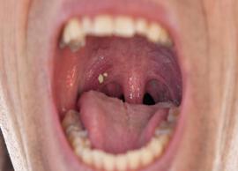 10 Natural Remedies for Tonsil Stones Treatment