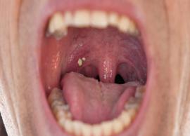 5 Home Remedies To Get Rid of Tonsil Stones