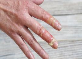 13 Remedies That Will Help To Treat Burns On Fingers