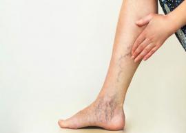 5 Home Remedies To Treat Varicose Veins