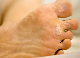 11 Remedies For Warts That Can Help To Cure Them
