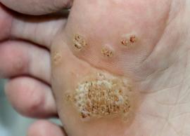 6 Effective Remedies To Treat Warts Naturally