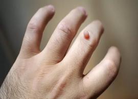 5 Effective Home Remedies To Get Rid of Warts