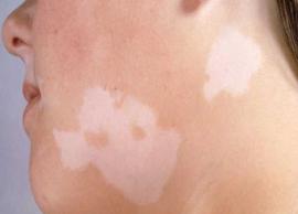 6 Reasons That Might Cause White Spots on Your Skin