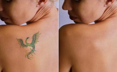 Want To Get Rid of laser Tattoo? Here are Few Easy Ways